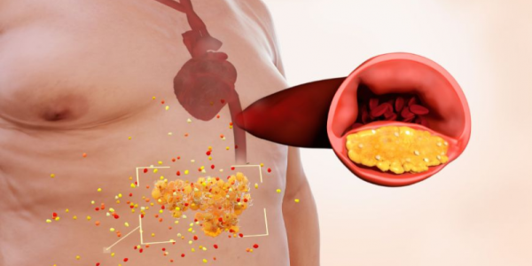 Aterosclerosi: Sintomi, Cos'è e Terapia